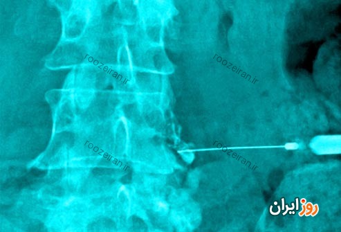 کمر درد چیست؟ روش پیشگیری و درمان