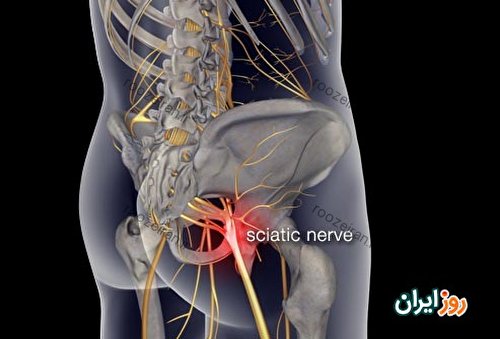 کمر درد چیست؟ روش پیشگیری و درمان