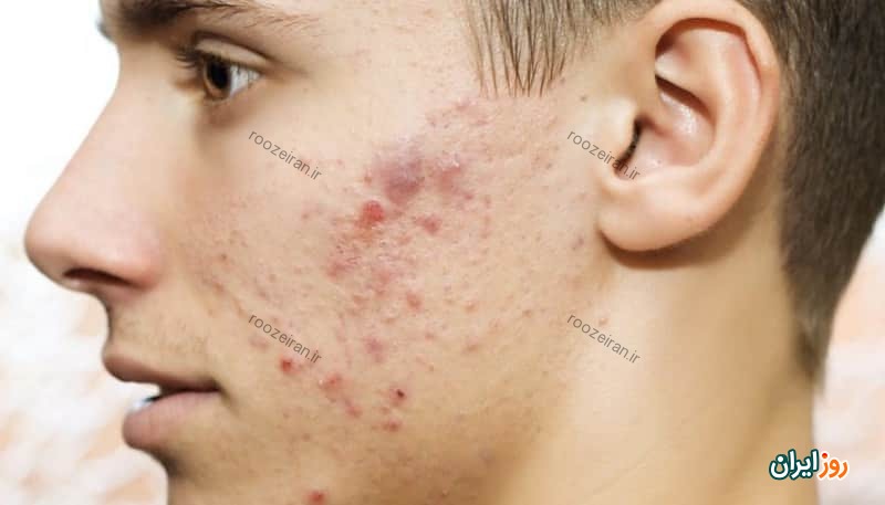 جوش صورت چیست و روش های درمان خانگی و پزشکی
