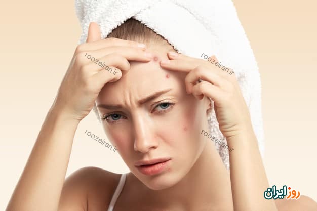 جوش صورت چیست و روش های درمان خانگی و پزشکی