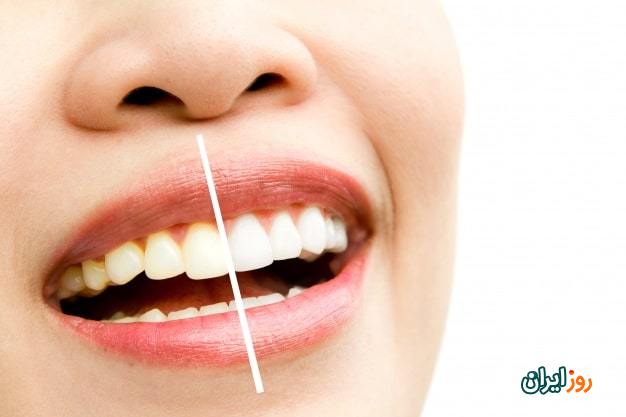 روش‌های سفید کردن دندان، روش‌های مرسوم و خانگی