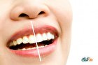 روش‌های سفید کردن دندان؛ روش‌های مرسوم و خانگی