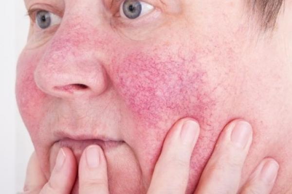 روزاسه چیست؟ از علائم تا درمان خانگی