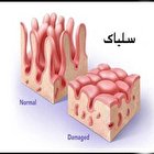 سلیاک، بیماری شایع اما ناشناخته