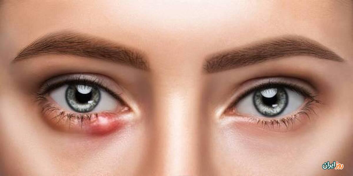 گل مژه یا جوش داخل چشم چیست و چگونه درمان می‌شود؟