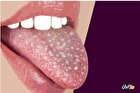 برفک دهان چیست؟ علائم و درمان پزشکی و دارویی آن