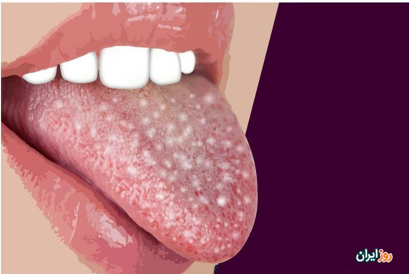 برفک دهان چیست؟ علائم و درمان پزشکی و دارویی آن