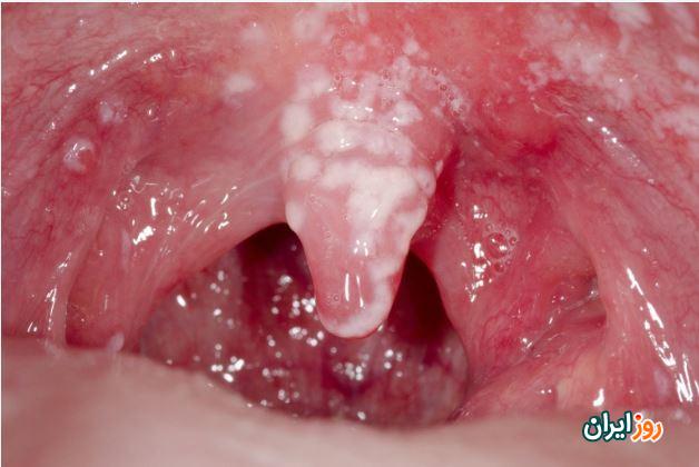 برفک دهان چیست؟ علائم و درمان پزشکی و دارویی آن