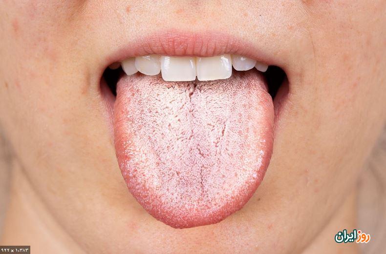 علائم و نشانه های برفک دهان در نوزادان و بزرگسالان